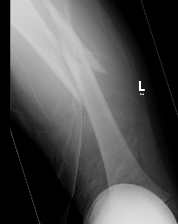 Pediatric Femoral Fracture Comminuted